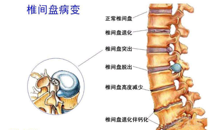 腰椎間盤突出症狀表現 (7) 