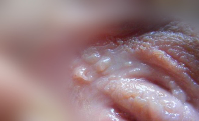 女性生殖器皰疹 (47) 