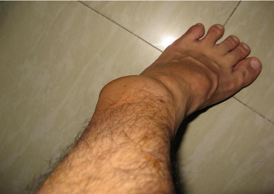 腳骨頭突出 (46) 