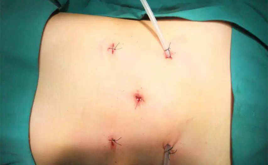 治療慢性結腸炎的