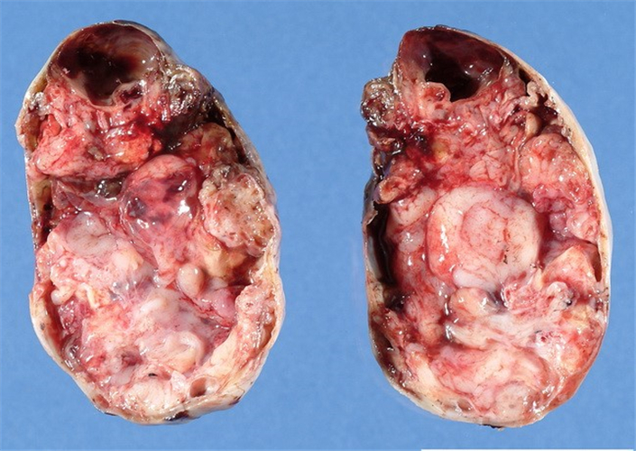 卵巢癌未成熟畸胎瘤剖面