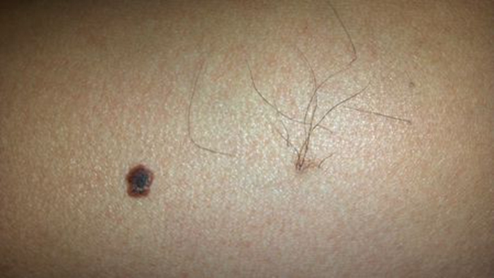 黑痣癌變