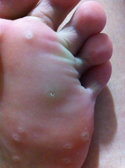 腳底蹠疣早期