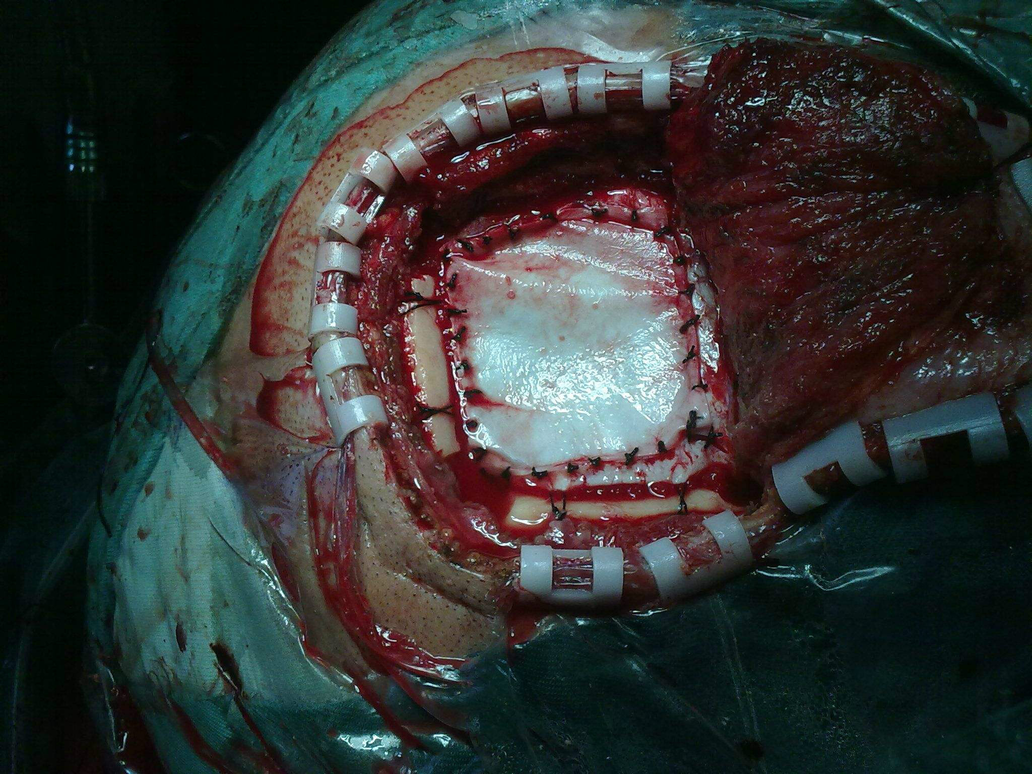 硬腦膜下血腫解剖圖 