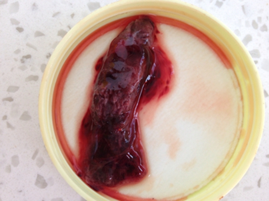 流產掉下來的孕囊