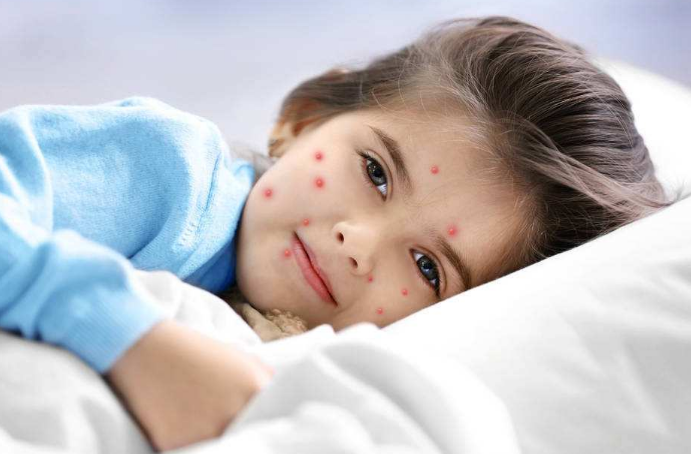 長水痘的症狀 (65) 