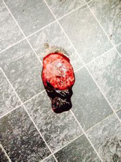 早孕藥流排出的孕囊的