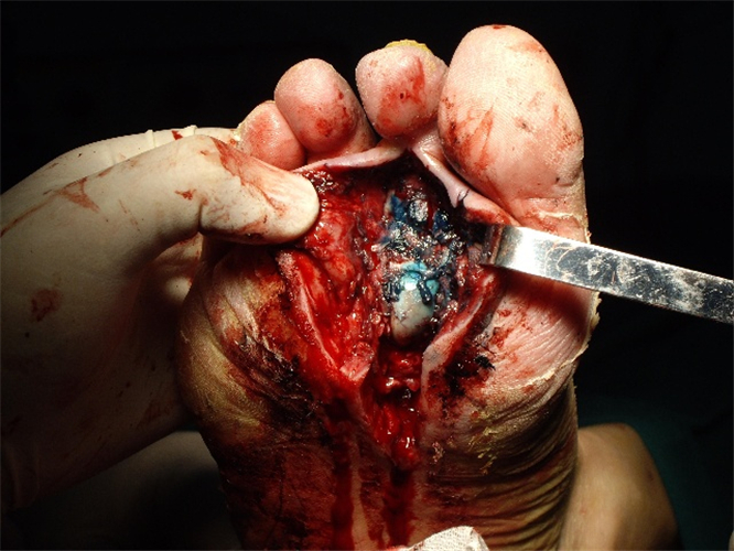 治療糖尿病足高清