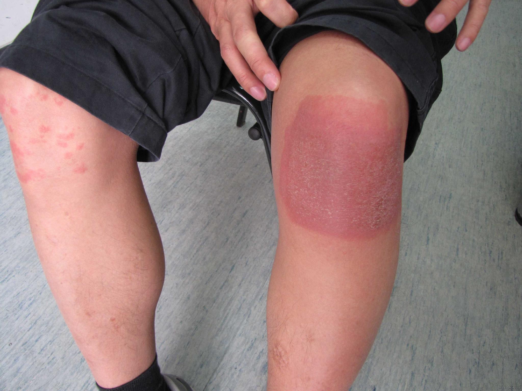 膝蓋日光性皮炎