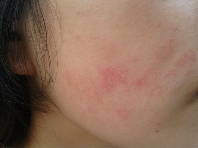 臉接觸性皮炎症狀