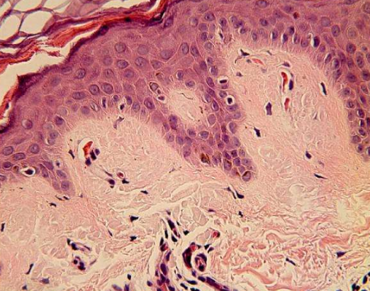 皮膚澱粉樣變 (9) 