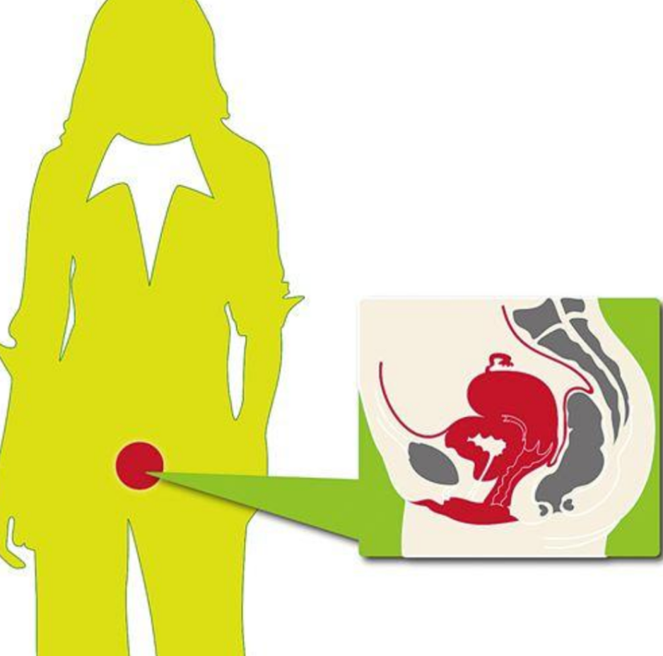 正在治療的人工陰道