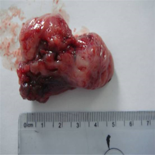 呼吸道感染者扁桃體發炎切除物