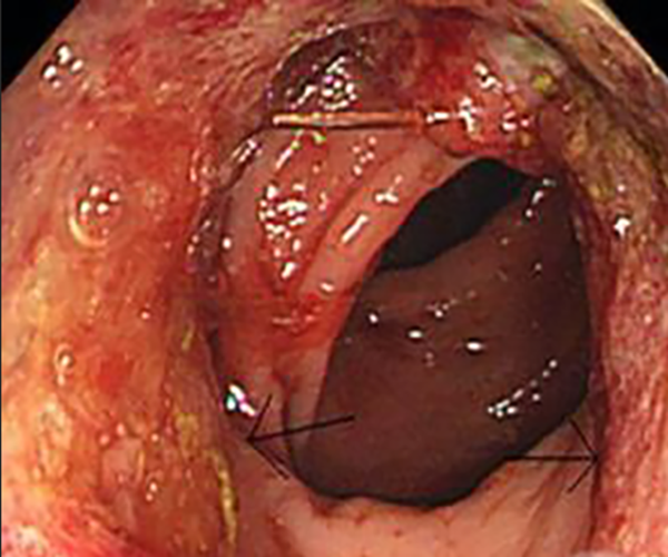 炎性胃息肉的症狀表現