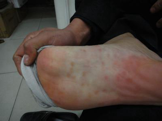 艾滋病紅疹症狀