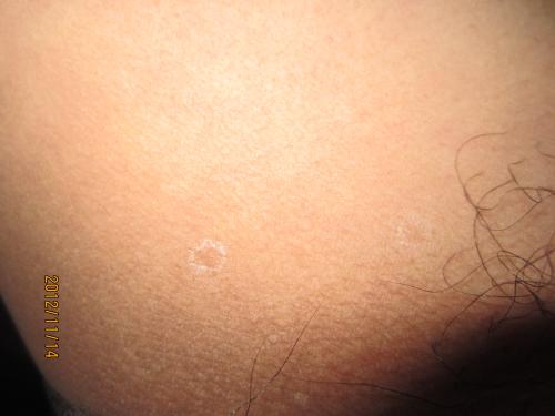 臀部癤子的症狀