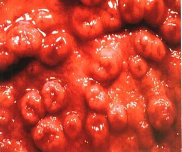 增生性胃息肉常見症狀