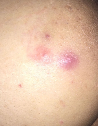 臀部癤子的症狀