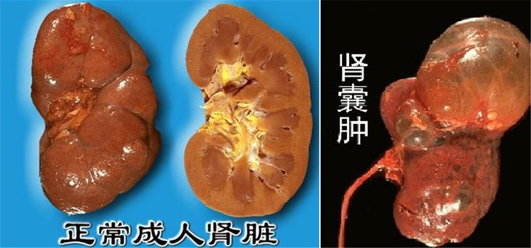 腎囊腫與正常腎對比