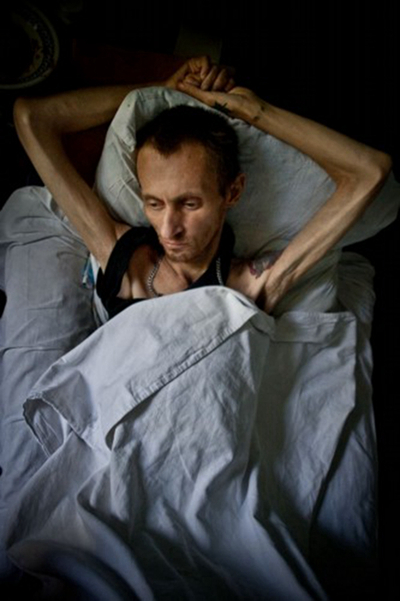 空洞型肺結核能活多久 (40) 