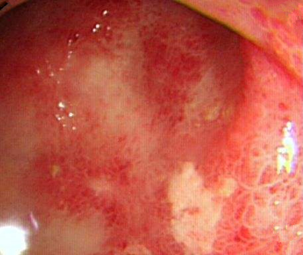 食療調理慢性結腸炎的