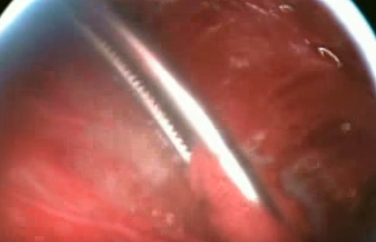 結核性胸膜炎有積液的