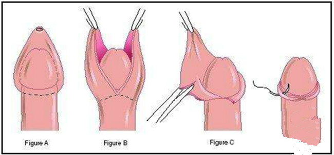 嵌頓包莖要這麼治療 