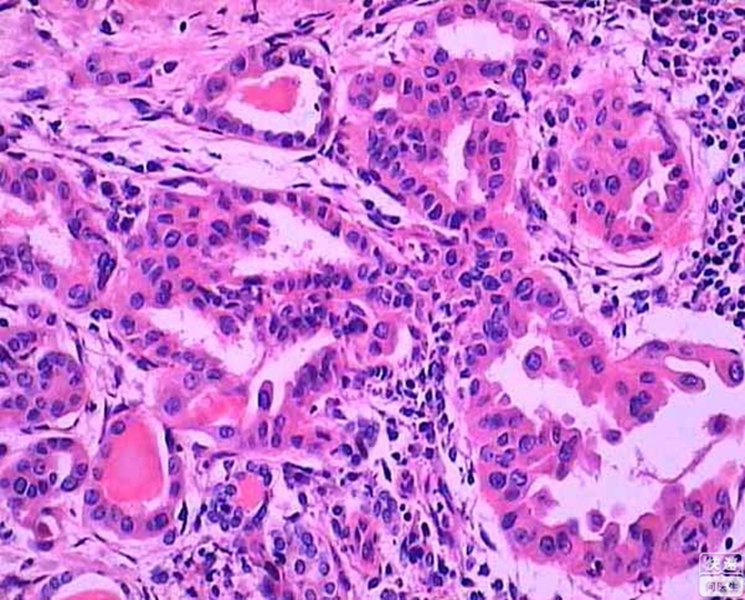 橋本甲狀腺炎細胞查看