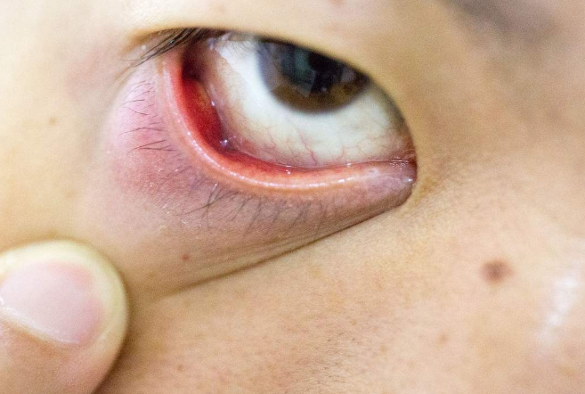 眼睛麥粒腫初期