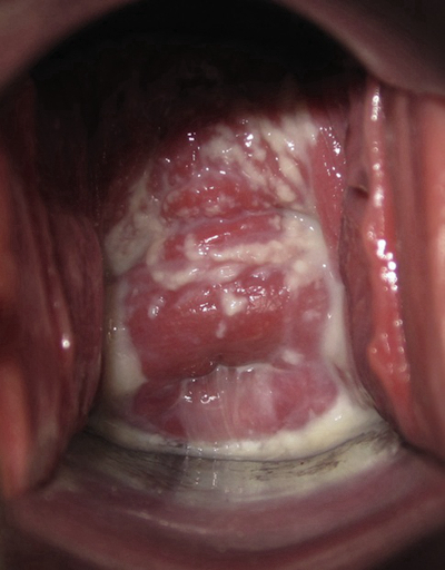 子宮肥大圖 (47) 