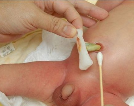 寶寶臍帶脫落後