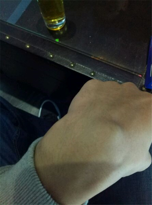 左手腕處腱鞘炎