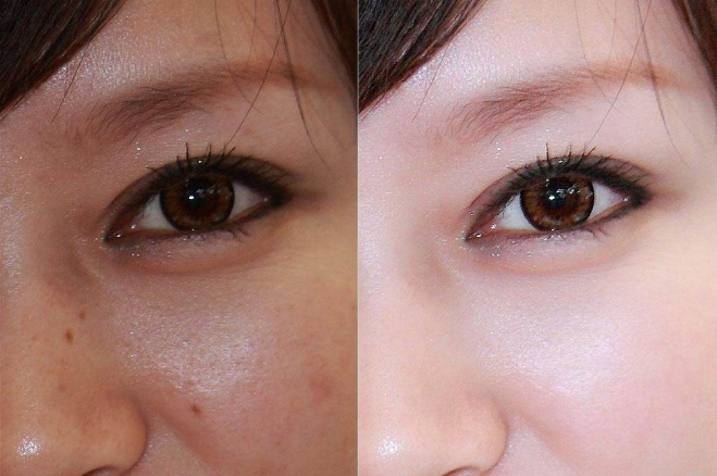 磨皮手術效果圖 (53) 