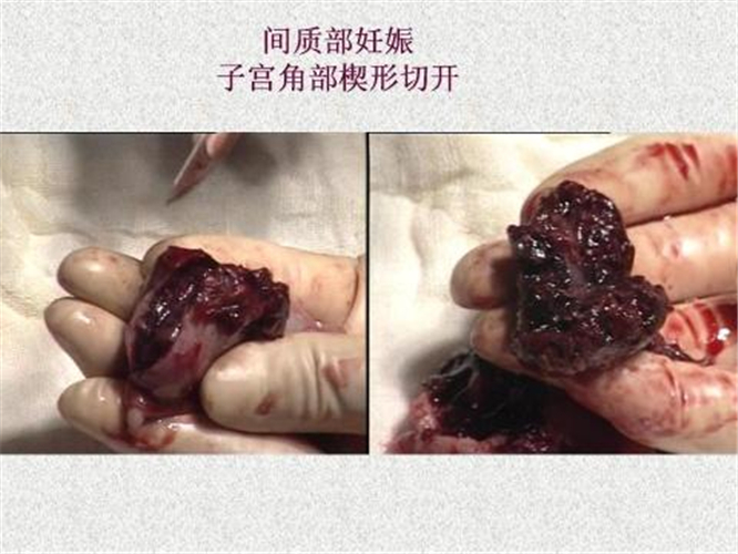 間質部宮外孕側切