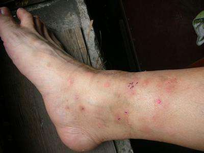 被跳蚤咬的症狀