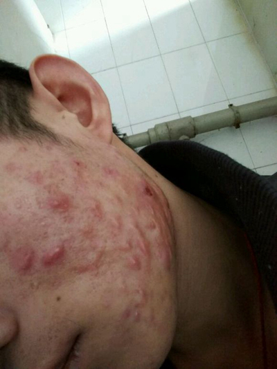 血熱的症狀痘痘