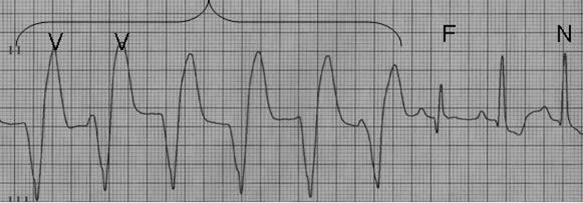 頻發房性早搏 (49) 
