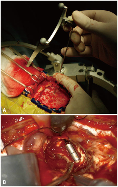 硬膜下血腫 (46) 