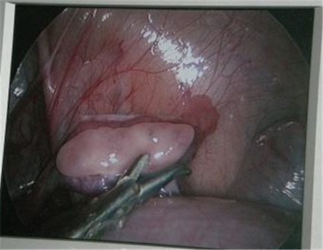 手術治療男性假兩性畸形生殖器