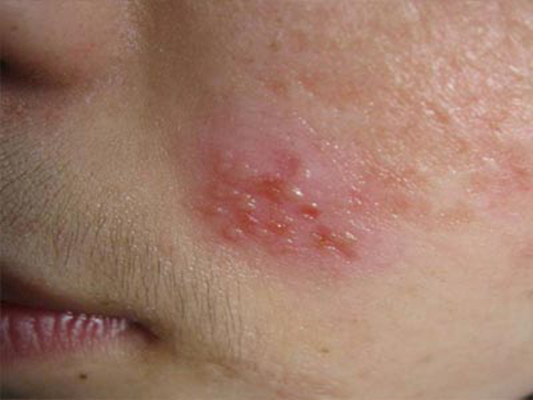 嘴上長皰疹 (51) 