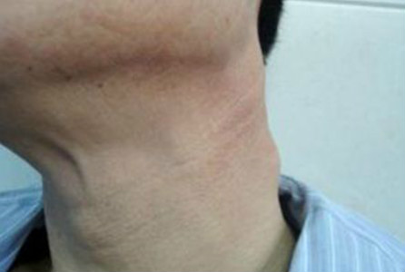 慢性淋巴結炎 (42) 