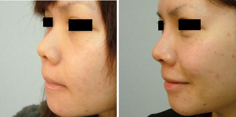 鼻子整形 (51) 