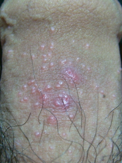 黴菌性龜頭炎 (9) 