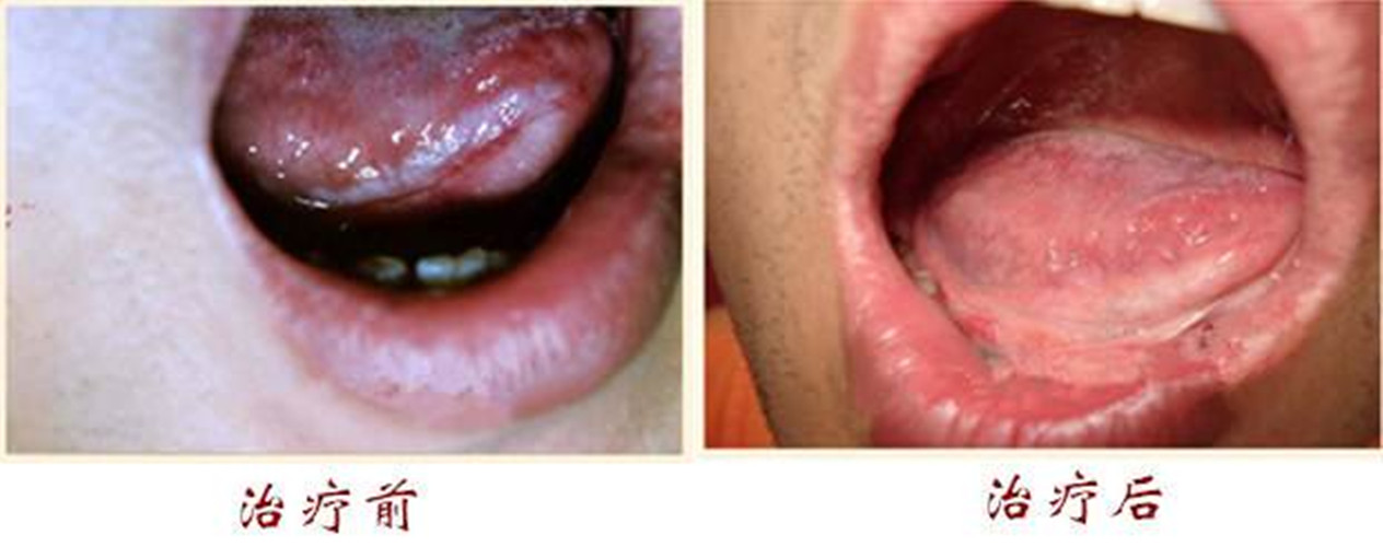 扁平苔蘚的艾灸 