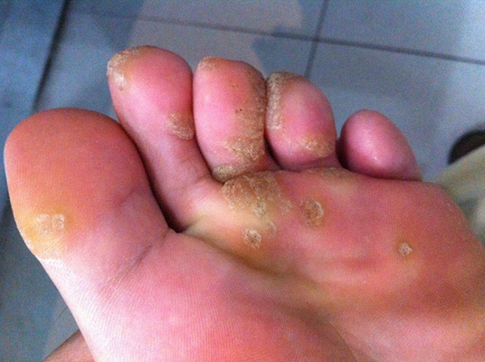 腳底蹠疣早期