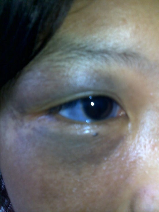 眼睛白眼球太田痣
