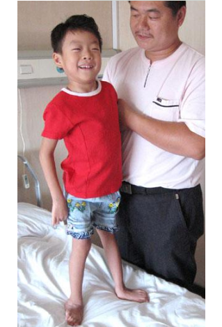 痙攣型腦癱 (48) 