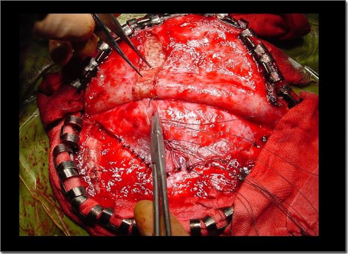 手術治療煙霧病引起的腦血管痙攣