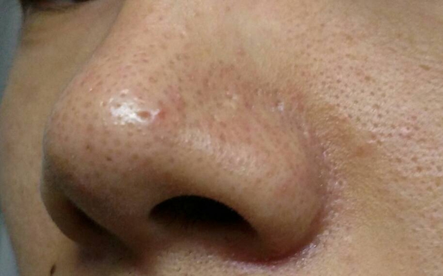 鼻子長蟎蟲症狀