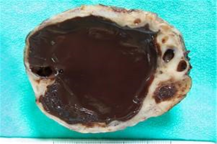 巧克力卵巢囊腫剖面